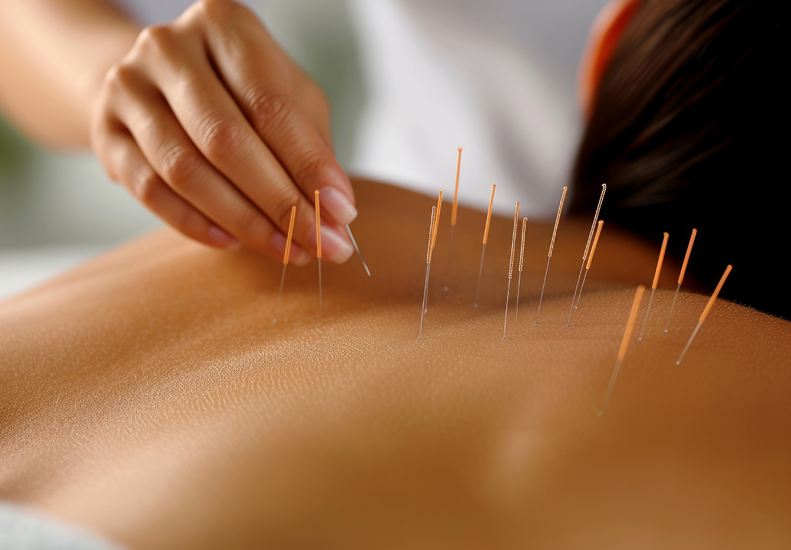 Acupuncture Session Treatment Back Neck Pain Relief Alternative Medicine